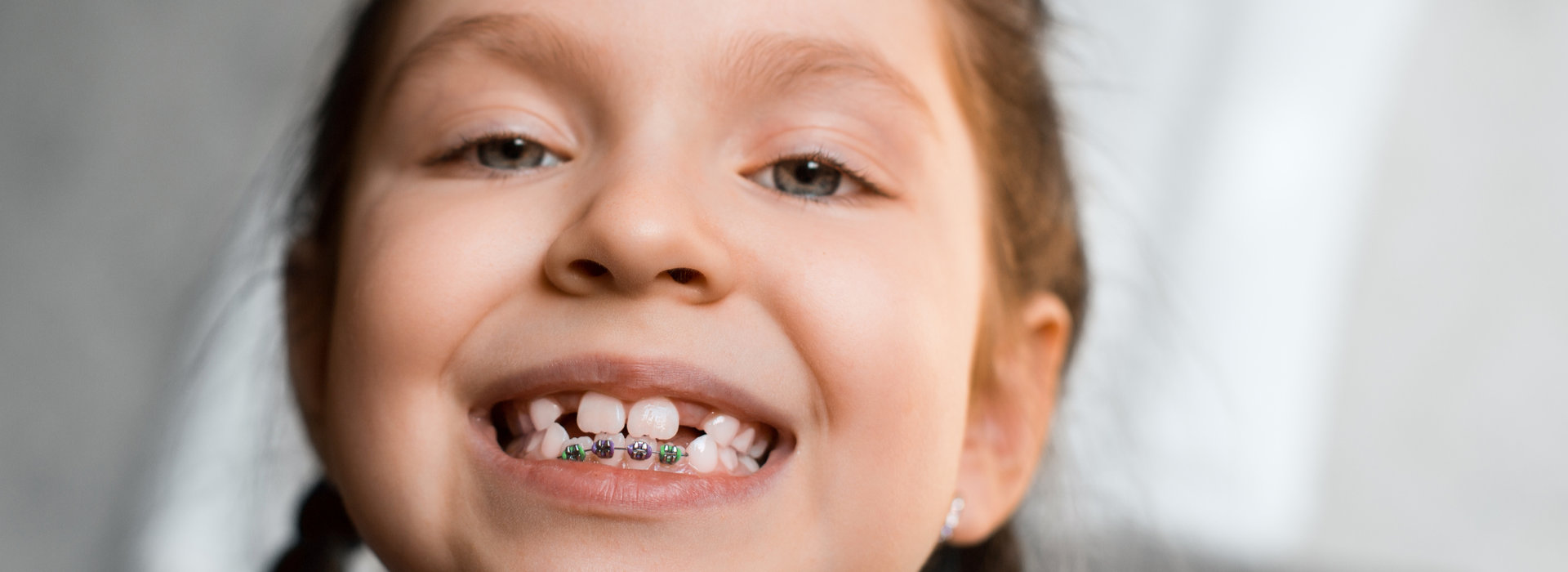 A child is smiling after early orthodontic treatment.