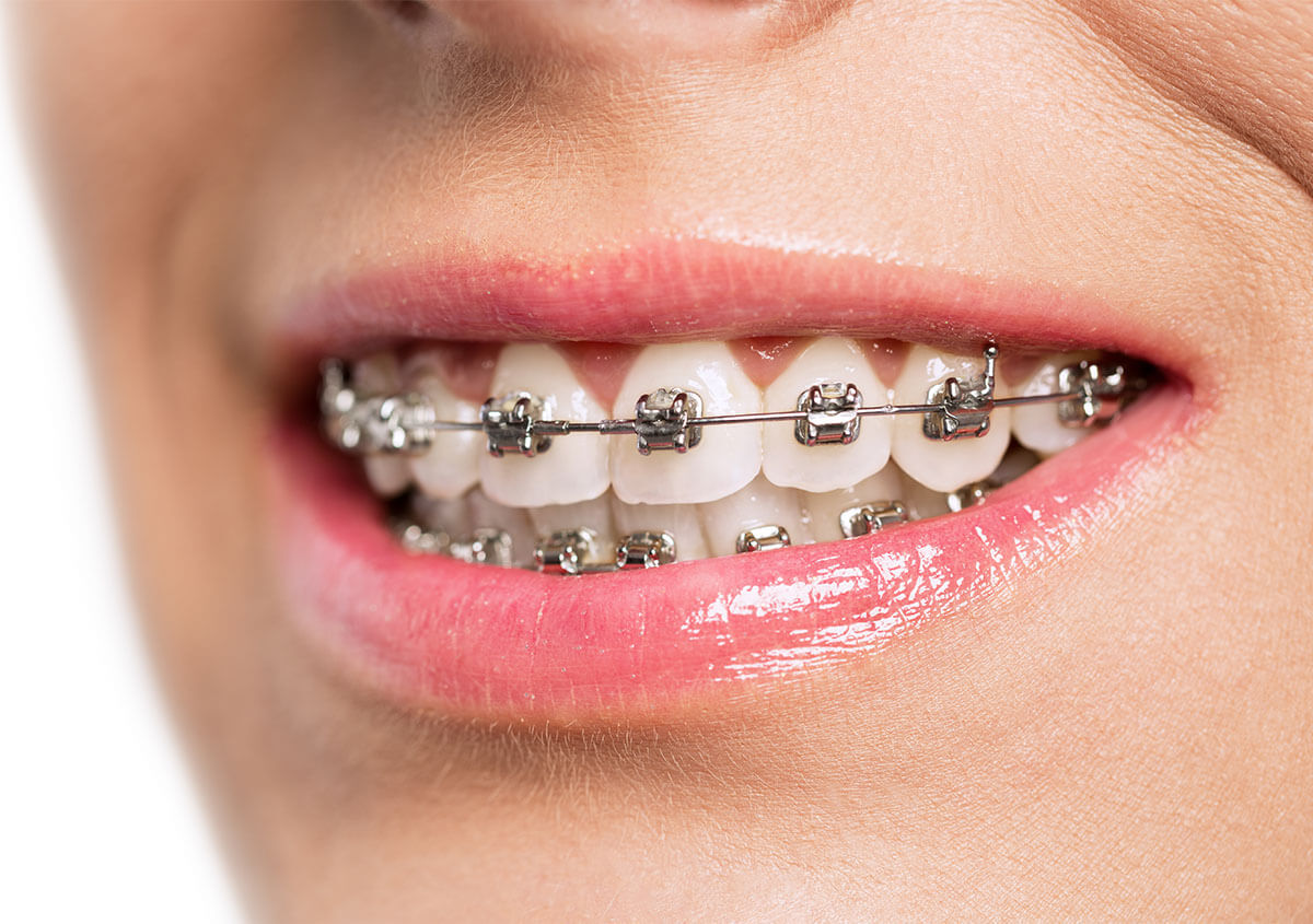 Traditional Braces for Adults in Columbus Ohio Area