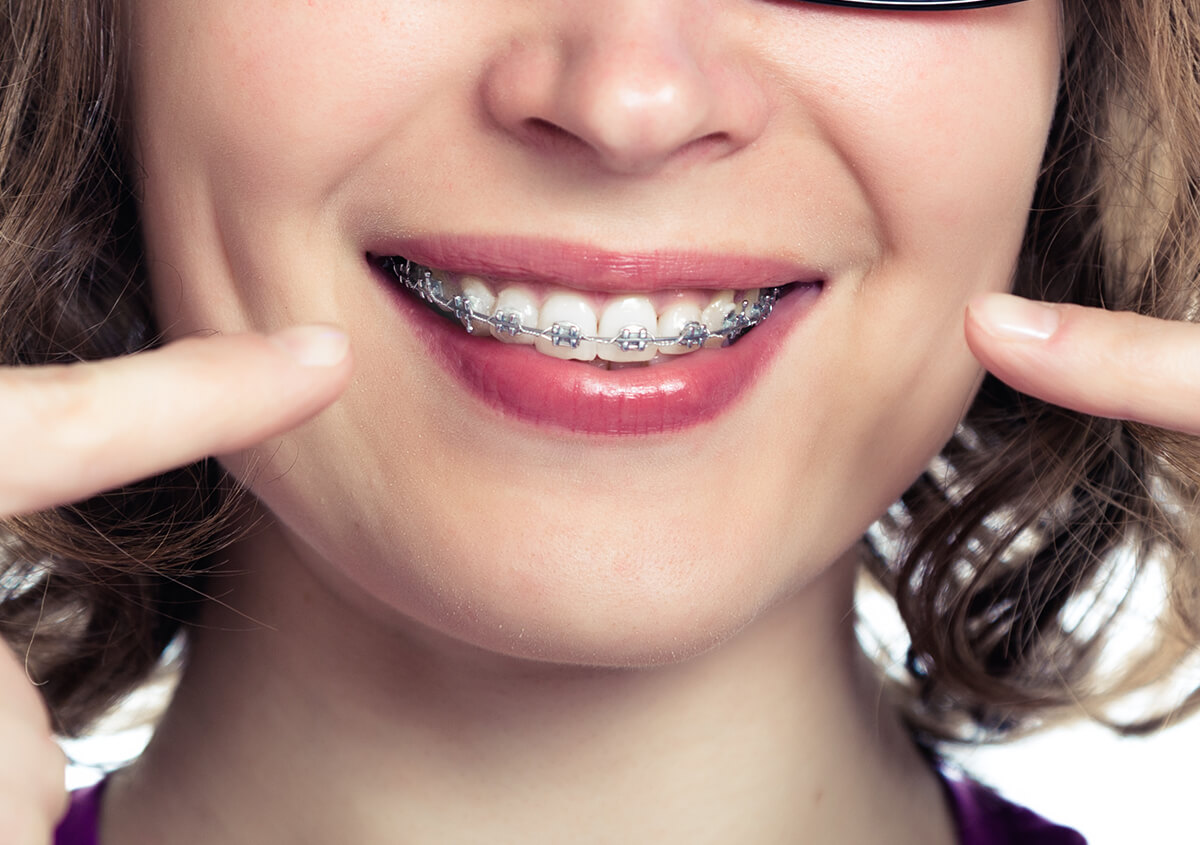 Dental Braces for Adults in Columbus OH Area